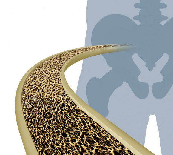 Osteoporosis Causes, Risk Factors, Complications, Diagnosis and Treatment