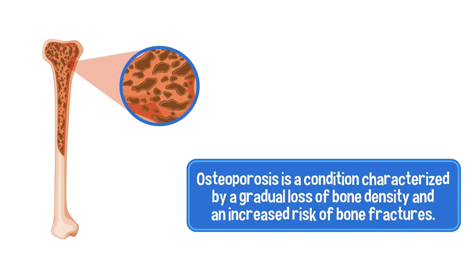 Osteoporosis meaning in Urdu infographic: illustration showing weakened bones