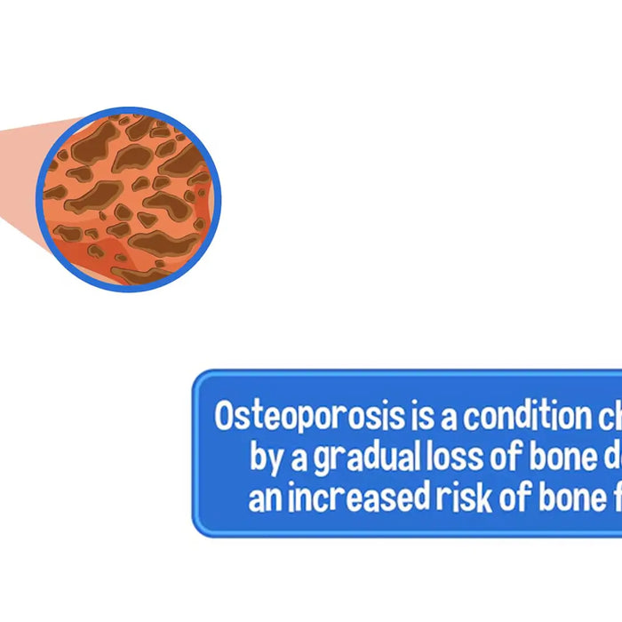 Osteoporosis meaning in Urdu infographic: illustration showing weakened bones